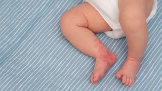 Close up of a Hemangioma red birthmark on leg of newborn baby. here we see a series of red splotches on the baby's right heel and ankle.