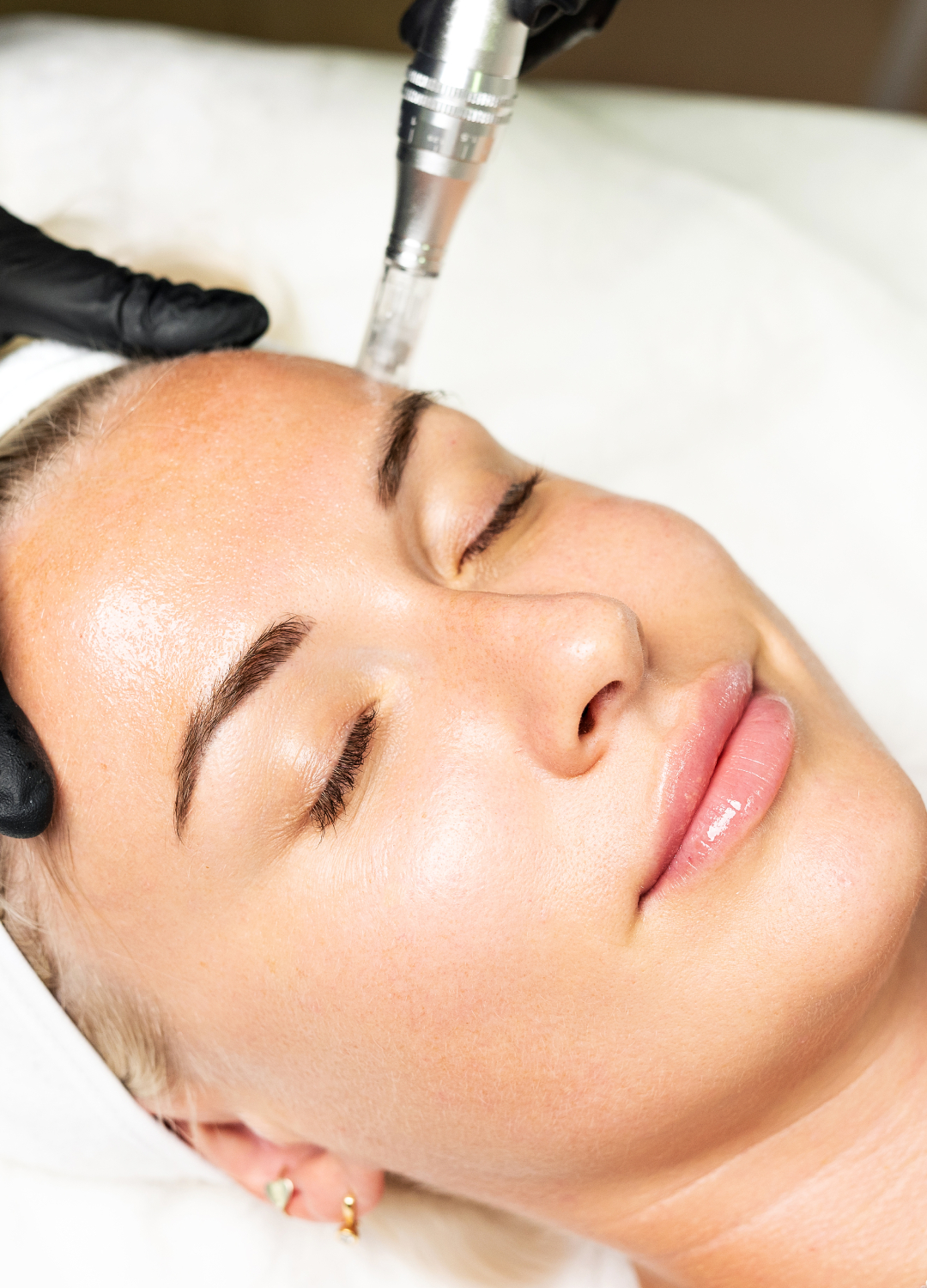 Microneedling