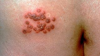 A demonstration of herpes zoster, the virus that causes symptoms of shingles