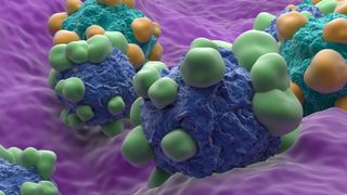 A 3D illustration of seven adenocarcinoma cells. shown in different shades of blue, embedded in the lining of an unspecified organ in purple