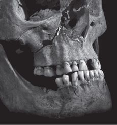 A photograph of Richard III's jaw and face show penetrating injuries to the maxilla, or upper jaw.