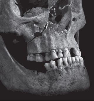 A photograph of Richard III's jaw and face show penetrating injuries to the maxilla, or upper jaw.