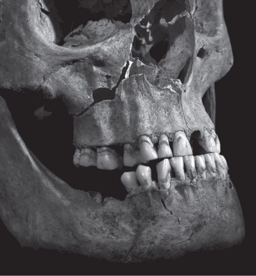 A photograph of Richard III&#039;s jaw and face show penetrating injuries to the maxilla, or upper jaw.