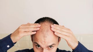 Close up of Young Caucasian man looking at mirror worried about balding.