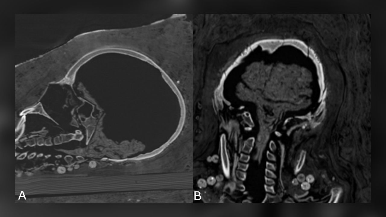 The teenager's brain had shrunk, but it was still preserved.