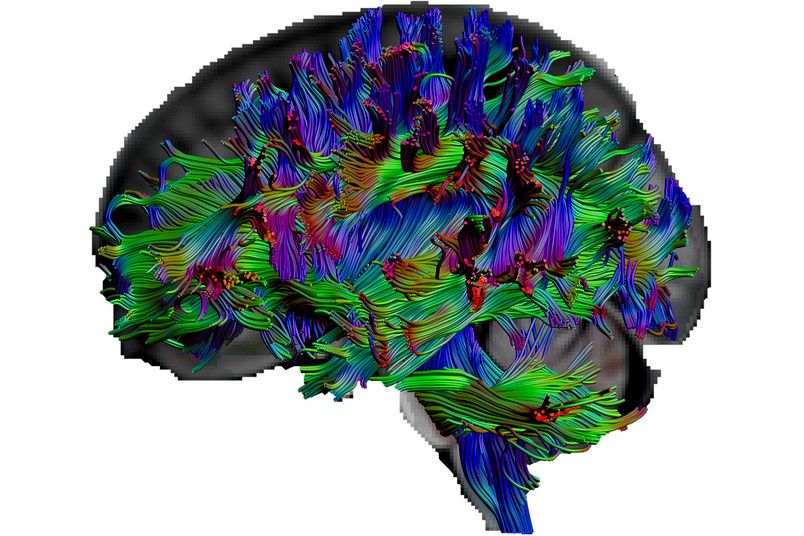 With a special kind of MRI called &quot;diffusion tensor imaging,&quot; the researchers were able to visualize pathways in the brain. 