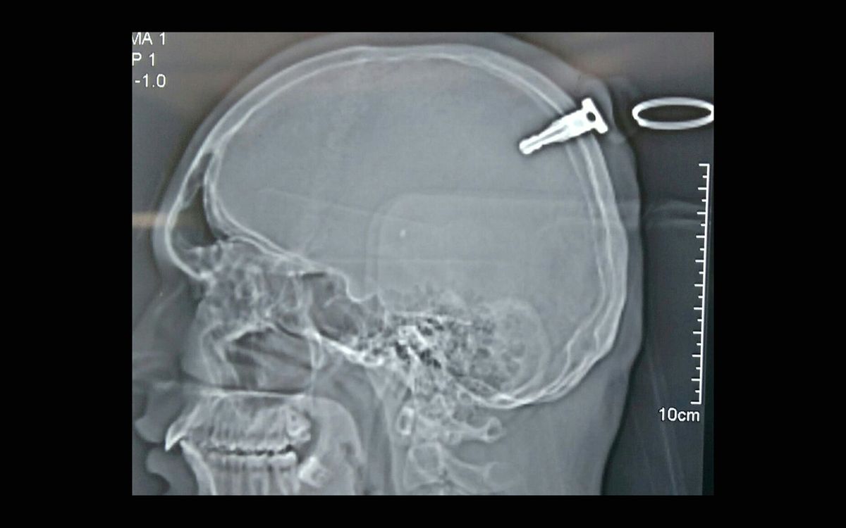 A brain scan shows a key lodged about 1.5 inches into a man&#039;s brain.