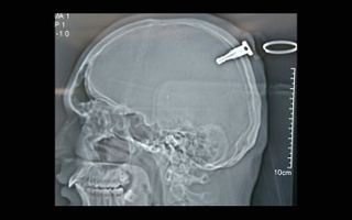 A brain scan shows a key lodged about 1.5 inches into a man's brain.