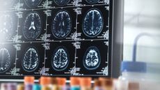 Brain scans of dementia patients in lab