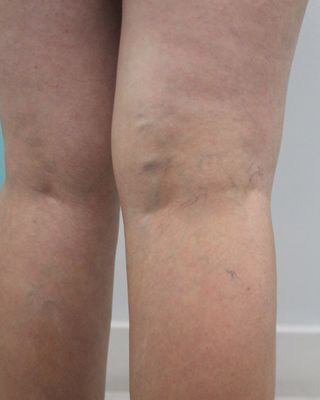 Dionne Brighton's right leg before varicose vein removal