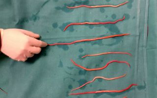 Doctors in India removed 14 roundworms from a patient's bile duct.