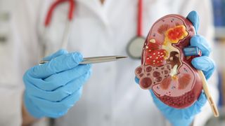 A gloved doctor uses a pen to point to a 3D medical model of a kidney