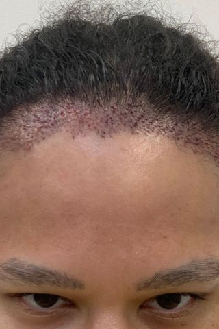 Amerley Ollennu straight after hair transplant surgery