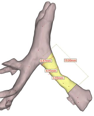 Images from a patient’s CT scan were used to generate a 3D model of the patient’s airway.