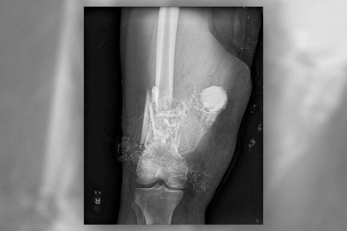 An X-ray showing a potentially explosive firework embedded in a patient&#039;s leg.