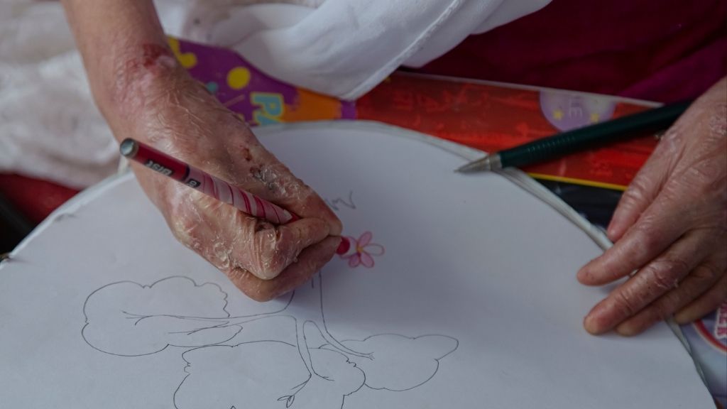 a photo of a child&#039;s hands, drawing a picture; the child has &quot;butterfly disease&quot; and their skin is visibly peeling and blistering