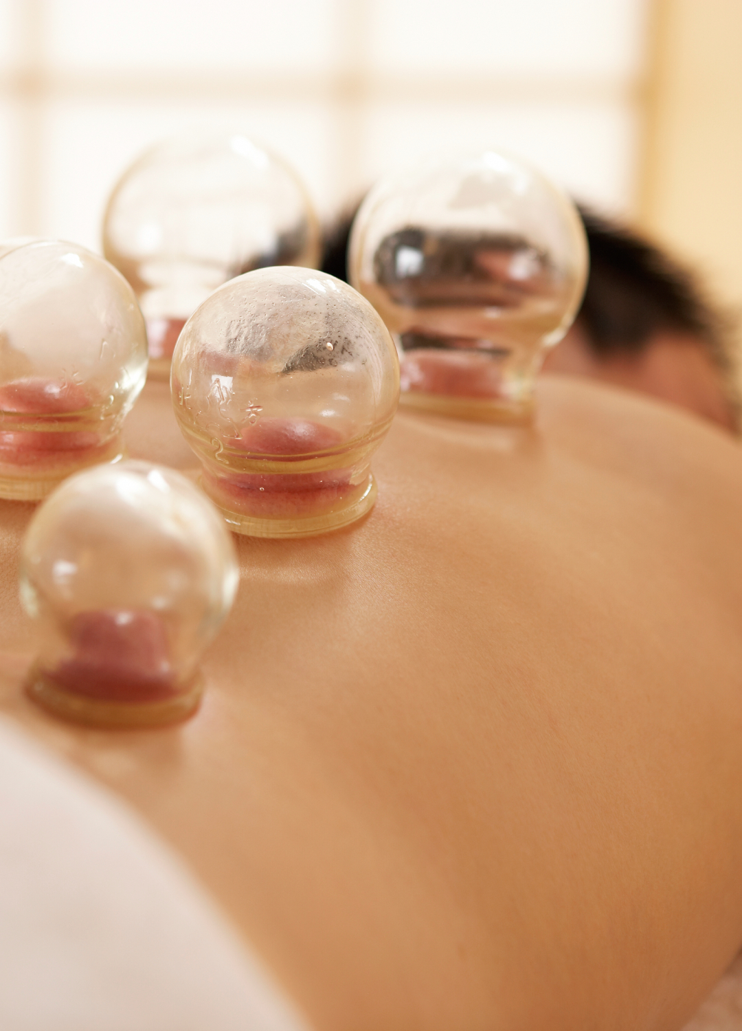Cupping