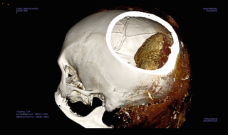A CT scan showed what looked like dark sediment inside the mummy's brain case.