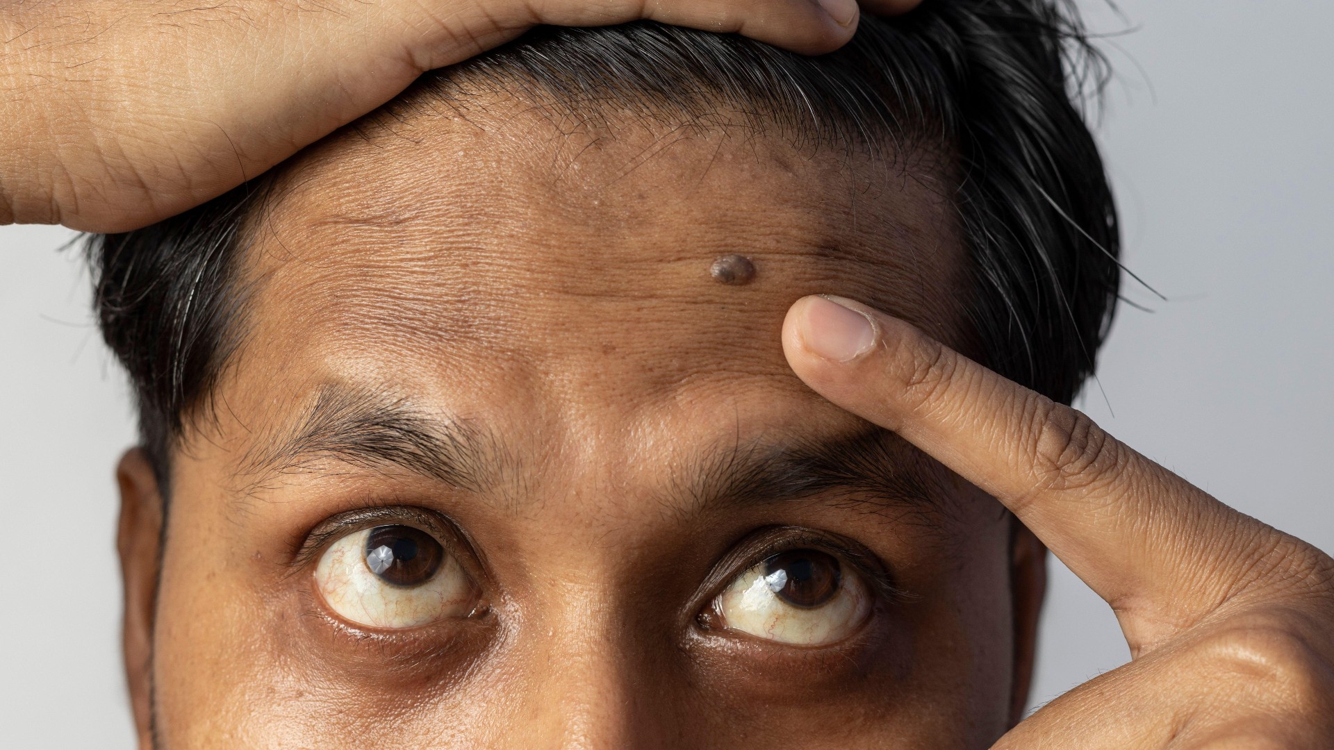 A man with dark brown skin and black hair pointing to a mole on his forehead.