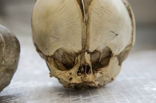 Close-up of full-term fetal skull from the University of Cambridge, circa 1911.