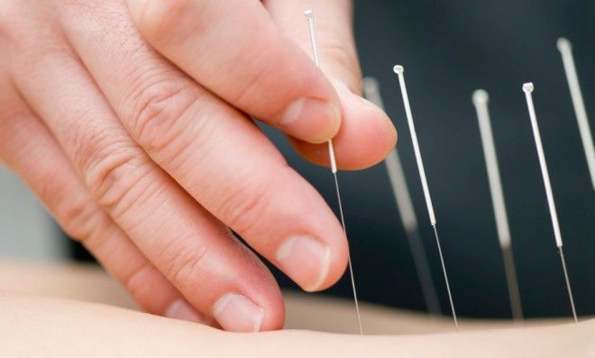 Acupuncture