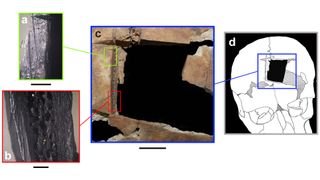 A square piece of bone about an inch across had been removed from the skull of the older brother, by scoring the bone and levering out pieces from the center. The researchers propose this was a trepanation, but their interpretation is disputed.
