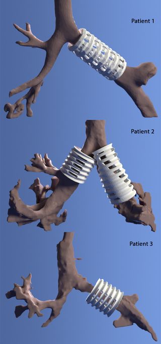 The airway splint was designed digitally to fit each of the patients.