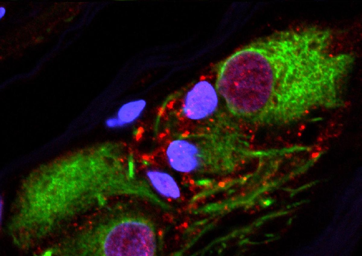 Clumps of alpha-synuclein protein (in red) were found in healthy appendixes. Those same clumps, when found in the brain, are a tell-tale signs of Parkinson&#039;s disease. 