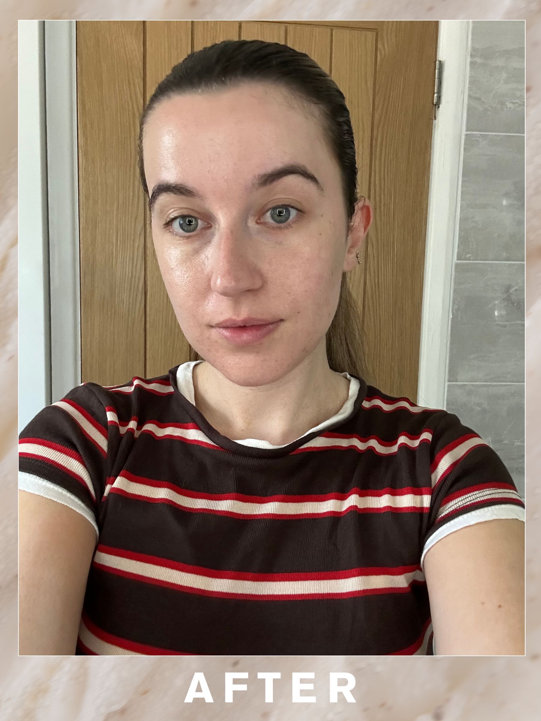 Grace after her Hydrafacial Pep9 facial