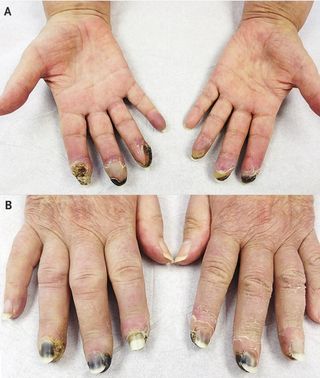 Black, necrotic tissue formed on the fingertips due to reduced blood flow.