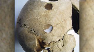 Three penetrating injuries on the right side of the skull of a young adult female from Potočani.