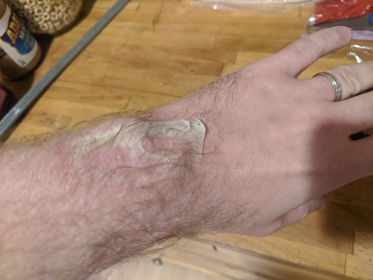 fitbit burn lawsuit
