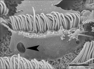 Damage to hair cells caused by low-frequency sound.