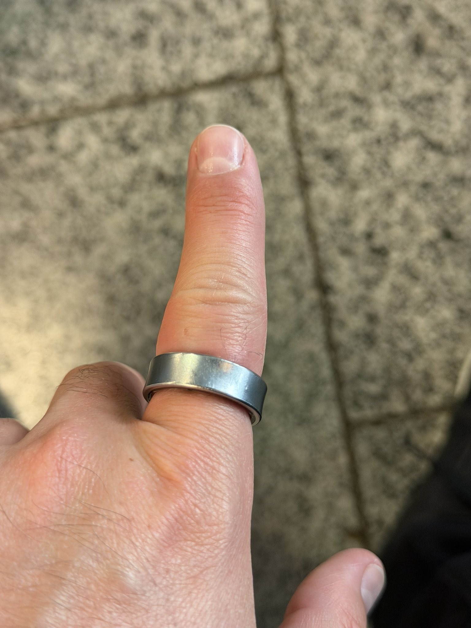 Swollen Samsung Galaxy Ring on the finger of Daniel Rotar