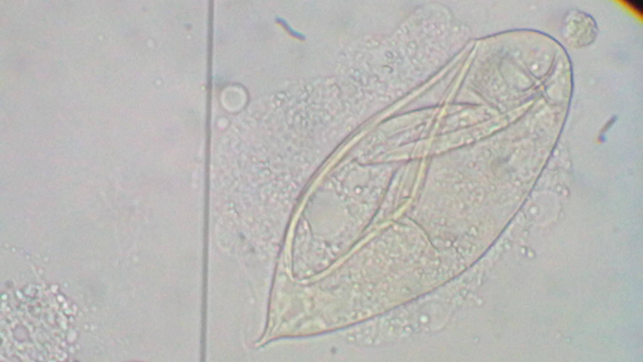 An image of a Schistosoma haematobium egg, a parasite that causes an infection.