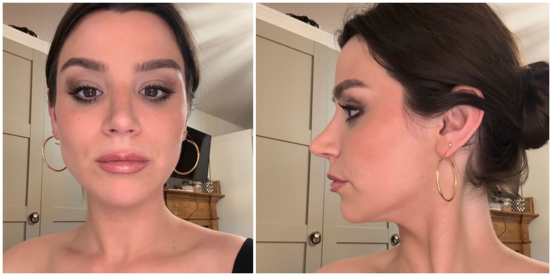 a girl at the three to four month post-op nose job