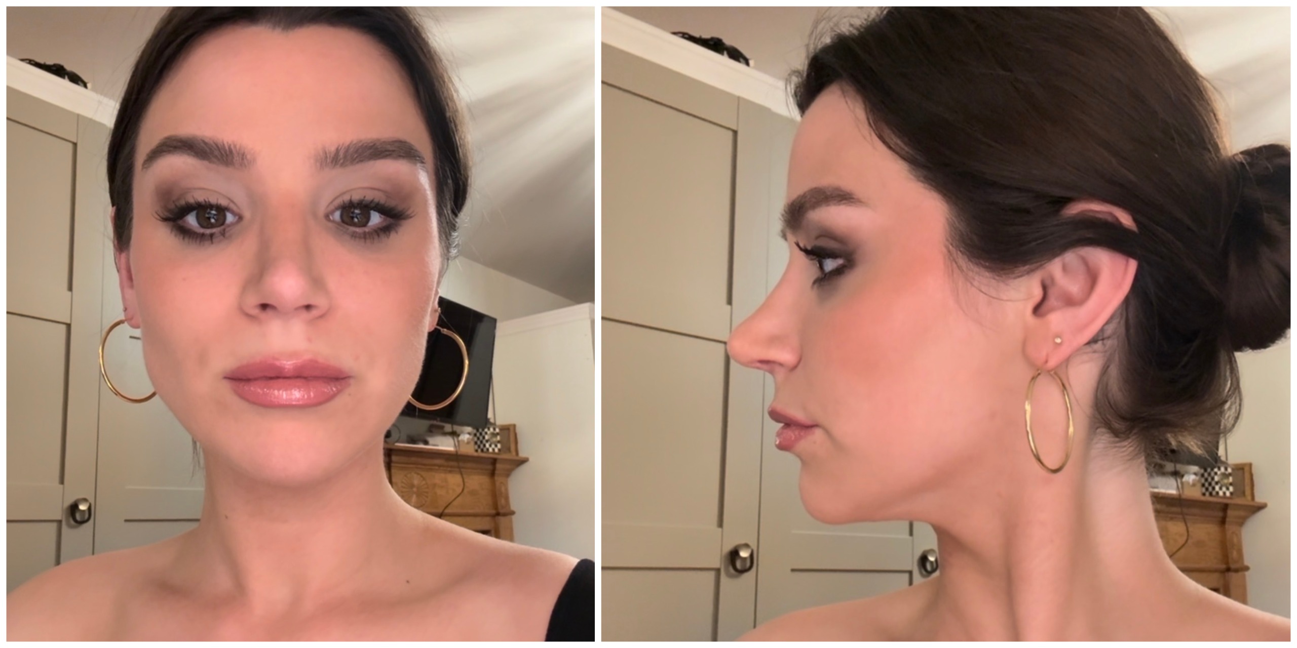 a girl at the three to four month post-op nose job