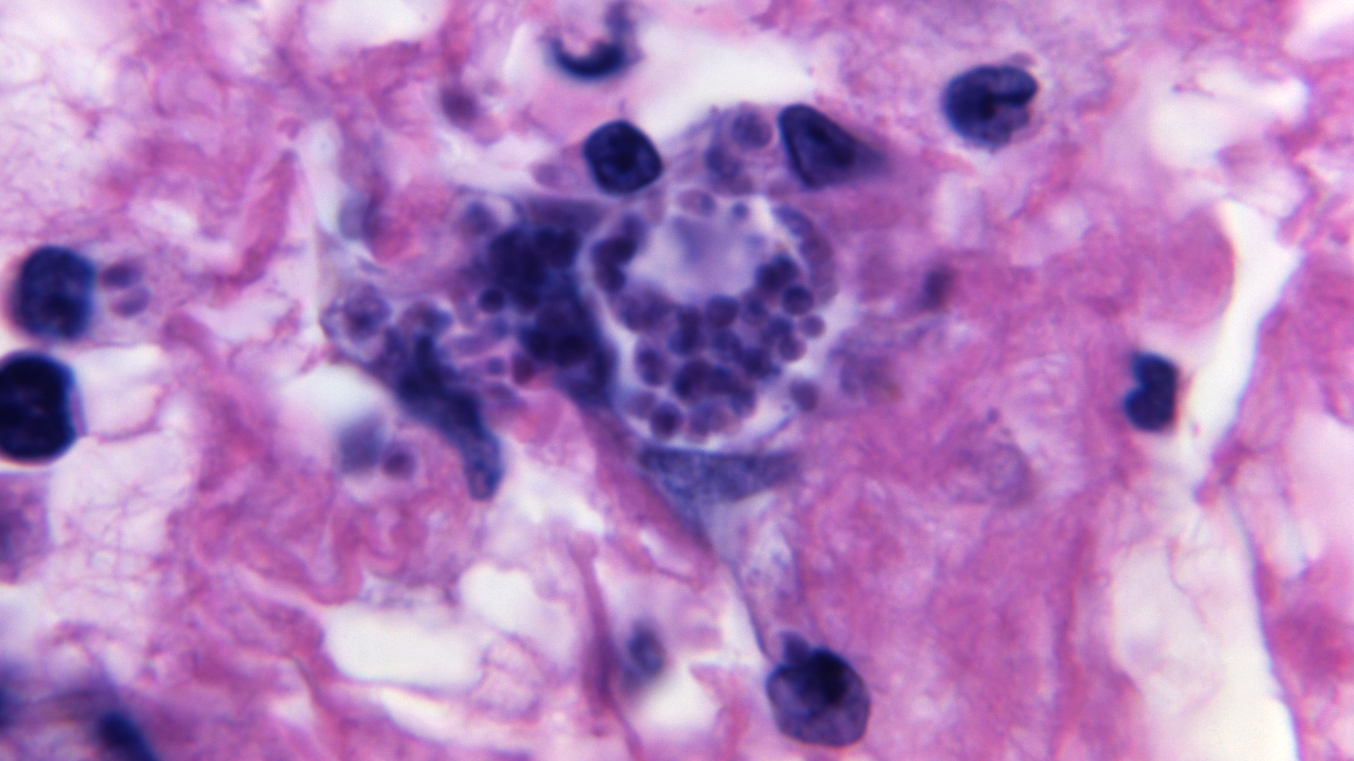 A view of a tissue sample that shows a Toxoplasma gondii cyst, the parasite that causes toxoplasmosis.