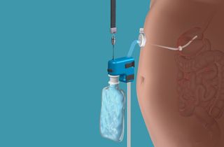 This image shows the AspireAssist device attached to the tube. Once in place, the contents of the stomach can be drained from the body.