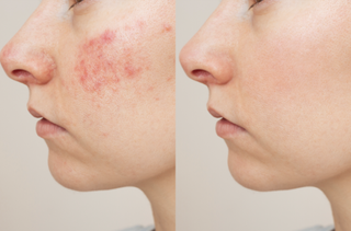 a side by side image comparing a person having a rosacea flare up to a person who is not having one