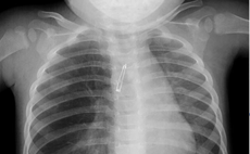 This x-ray shows the object lodged in the girl's right bronchus.
