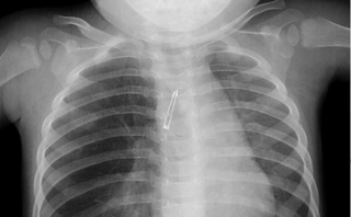 This x-ray shows the object lodged in the girl's right bronchus.