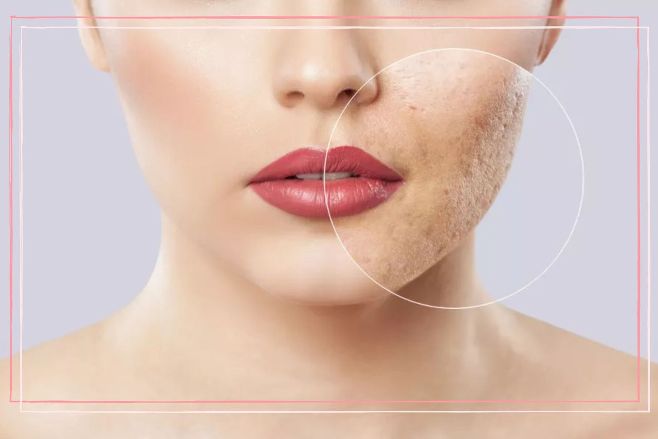 a close up of a women&#039;s face with a magnifying glass on her acne scars