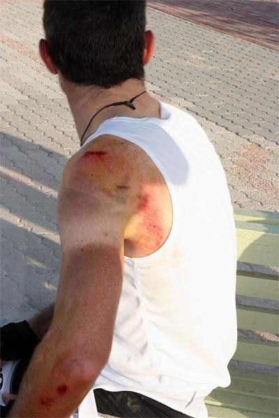 A bruised and bloodied Julian Dean