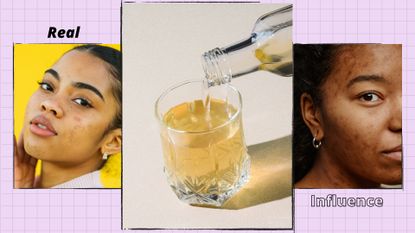 Apple Cider Vinegar for acne: two images of women with acne/ blemishes on the skin alongside a picture of a glass of apple cider vinegar/ in a purple 3-picture template