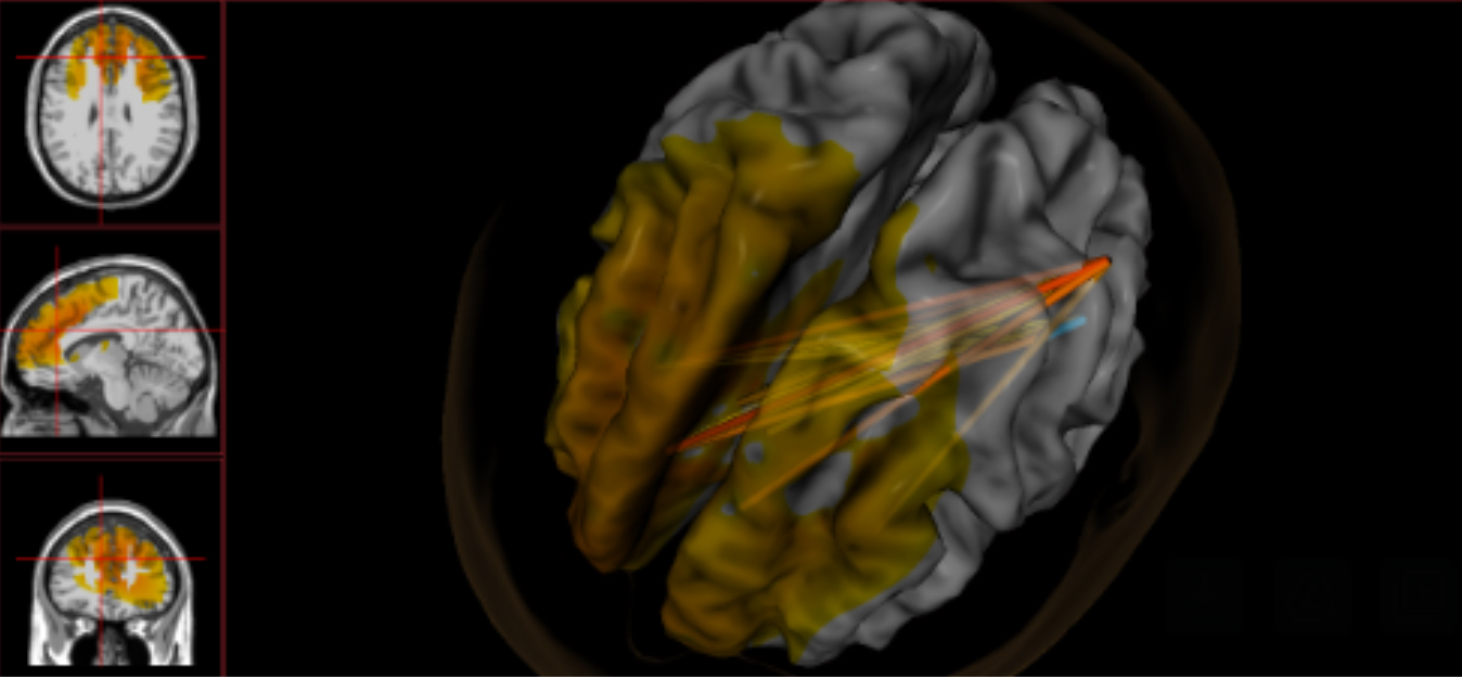 A scan showing the brain of a patient with intractable chronic pain and migraine prior to hearing the song “Soul to Soul.” “Anything orange is the most extreme five percent of dysregulation,” Minton says. “You do not want your brain to be there.”