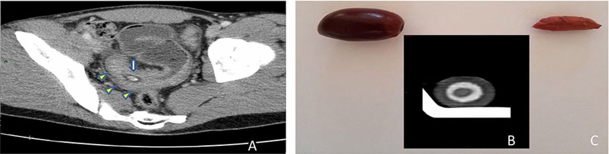 How A Ct Scan Of An Olive Led To Man S Diagnosis Of Crohn S Disease Live Science