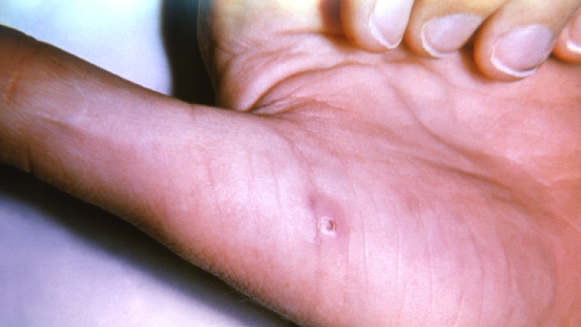 A photograph of a patient's hand with a lesion caused by a cat scratch