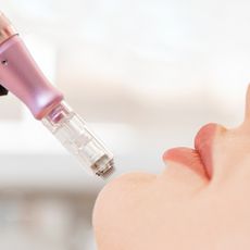 woman getting microneedling treatment