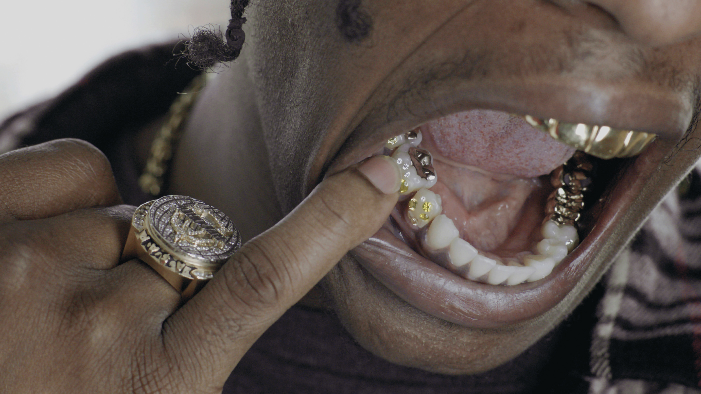 gold teeth